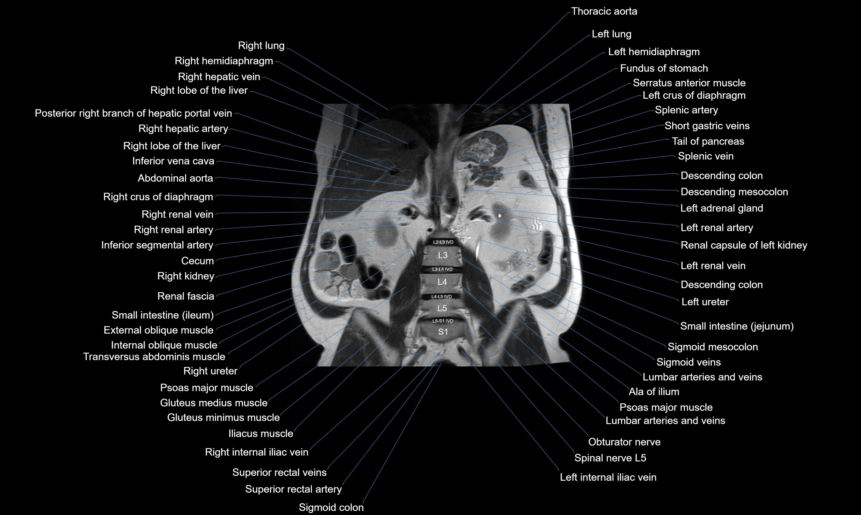 MRI Abdomen axial cross sectional anatomy radiology  image-img-00001-00035.webp